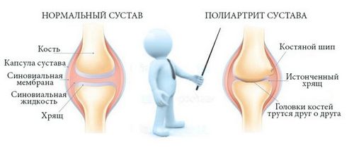 як лікувати суглоби імбиром