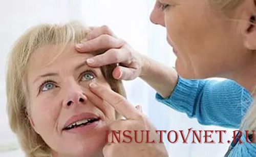 як лікувати очної інсульт