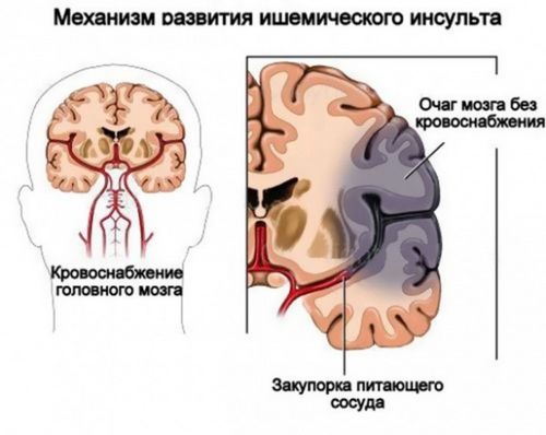 як лікувати інсульт головного мозку