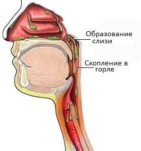 як вилікувати мокроту в горлі