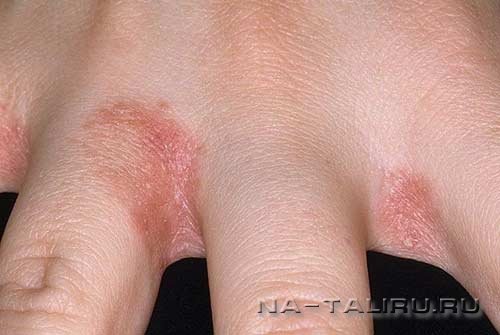 як лікувати дерматит на руках