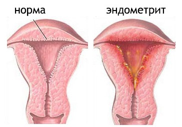 як лікувати ендометрит матки в домашніх умовах