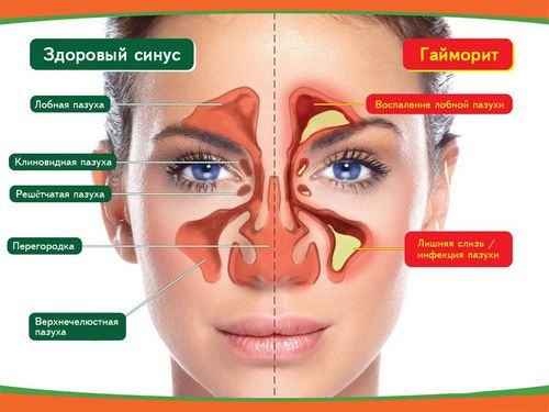 як вилікувати нежить гайморит