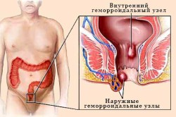 як вилікувати геморой без ліків