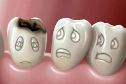 лікувати карієс на зубах