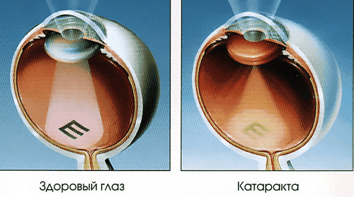 як лікувати катаракту очі