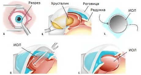 як лікувати катаракту очі