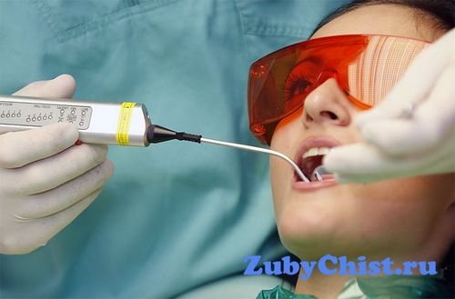 лікувати кіста зуба