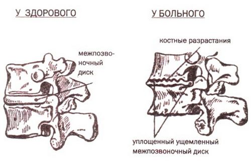 остеохондроз грудного відділу 2 ступеня