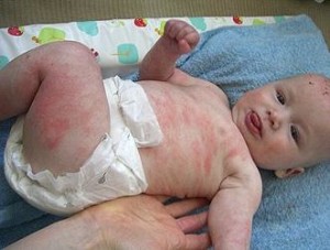 як вилікувати харчову алергію у немовляти