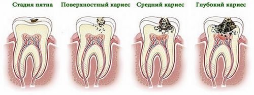 карієс зубів