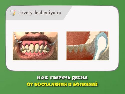 як можна вилікувати запалені ясна