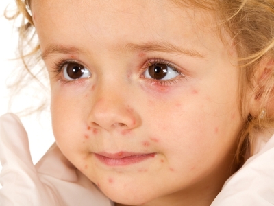 як вилікувати алергію немовля харчова