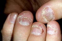 як лікувати псоріаз нігтів в домашніх умовах