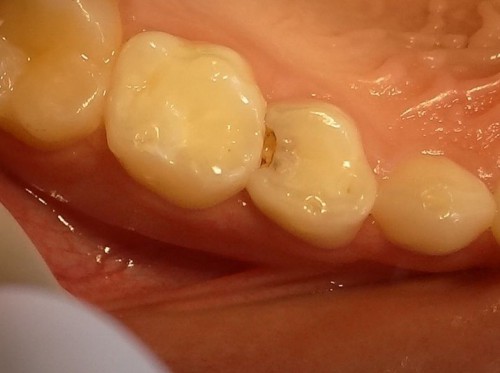 лікування молочний зуб діти карієс фото дитячий причина