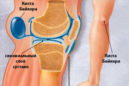як лікувати кісту в коліні
