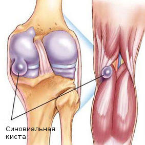 як лікувати кісту колінного суглоба