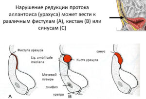 як лікувати кісту сечового міхура