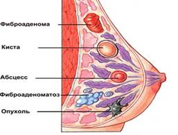 кіста молочна залоза груди пальпація мамографія мамолог фіброзна протоковая полікістоз атипова мастопатія