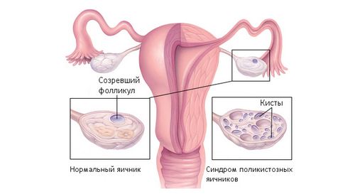 як вилікувати кісту лівого яєчника