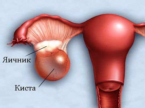 як вилікувати кісту лівого яєчника