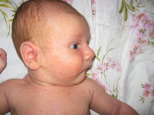 кропив'янка у немовлят фото симптоми і лікування