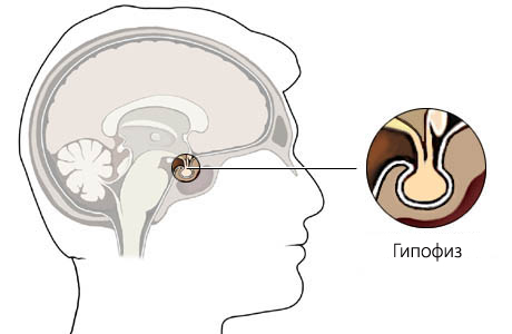 як вилікувати кісту гіпофіза