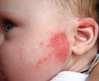 як лікувати алергію у дитини