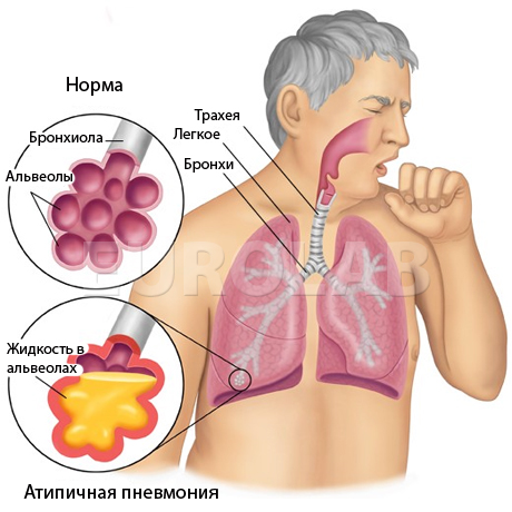 як лікувати атипову пневмонію