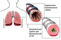 лікування астми