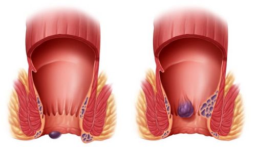 як вилікувати геморой народними засобами