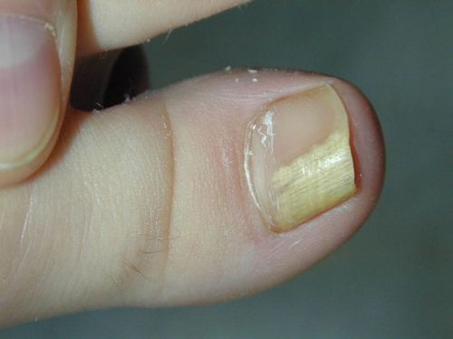 лікування грибок нігті чайний гриб нігтьової