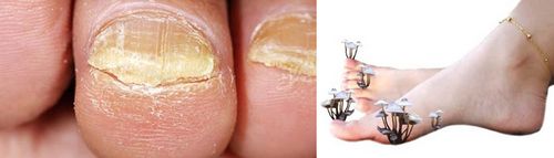 лікування грибка нігтів на ногах