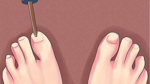 як правильно лікувати нігті йодом