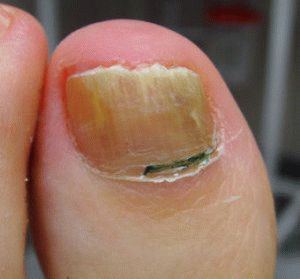 як вилікувати ніготь великого пальця на нозі