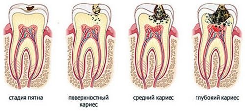 лікування карієсу молочних зубів