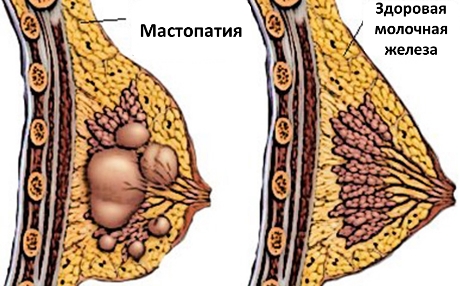 як лікувати мастит у жінок