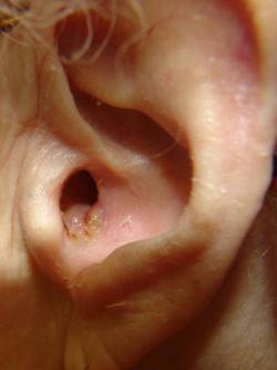отит лікування як лікувати середнього вуха зовнішній скільки лікується вух лікуємо будинку