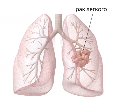 як лікувати рак легенів