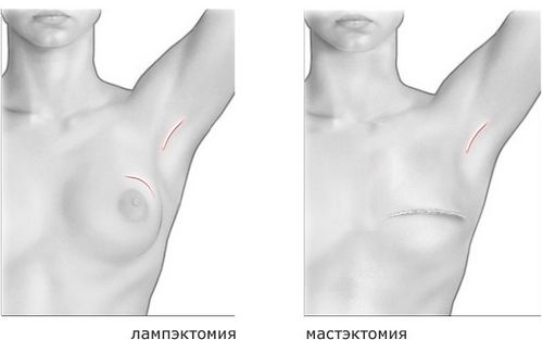 лікування раку молочної залози