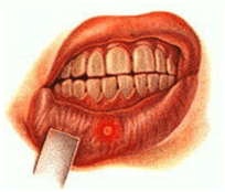 як лікувати частий стоматит