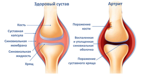 як лікувати суглоби адамовим яблуком