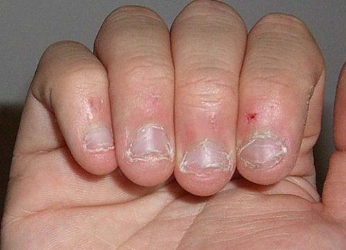 як лікувати тендітні нігті