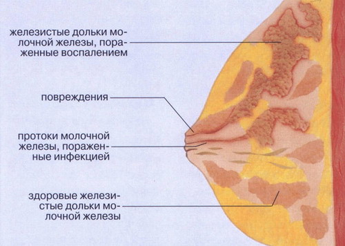 як починається мастит