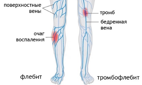 як лікувати судини ніг