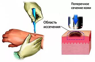 реально вилікувати рак 4 стадії