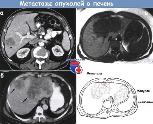метастази раку в печінці