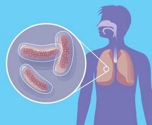 як лікувати туберкульоз кісток народними засобами