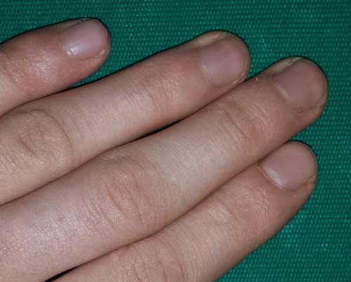 лікувати мікоз нігтів