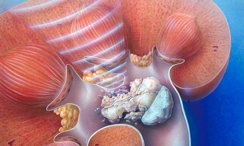 як лікувати мікролітіаз нирок